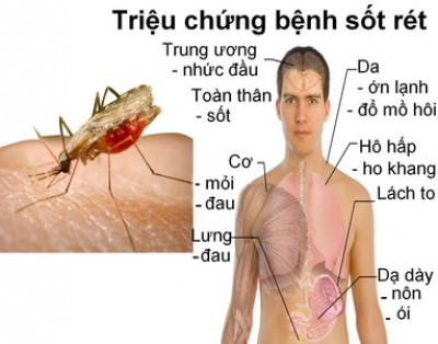 Biểu hiện của bệnh sốt rét và cách phòng chống